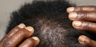 Dark hands on a scalp showing dandruff and dry hair