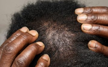 Hair Restoration Procedure: Process, Recovery, and Results Dark hands on a scalp showing dandruff and dry hair